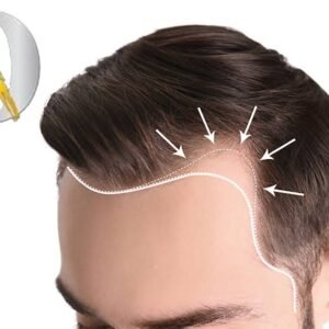 Hair Loss Profile