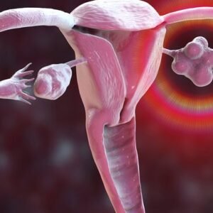Polycystic Ovary Syndrome
